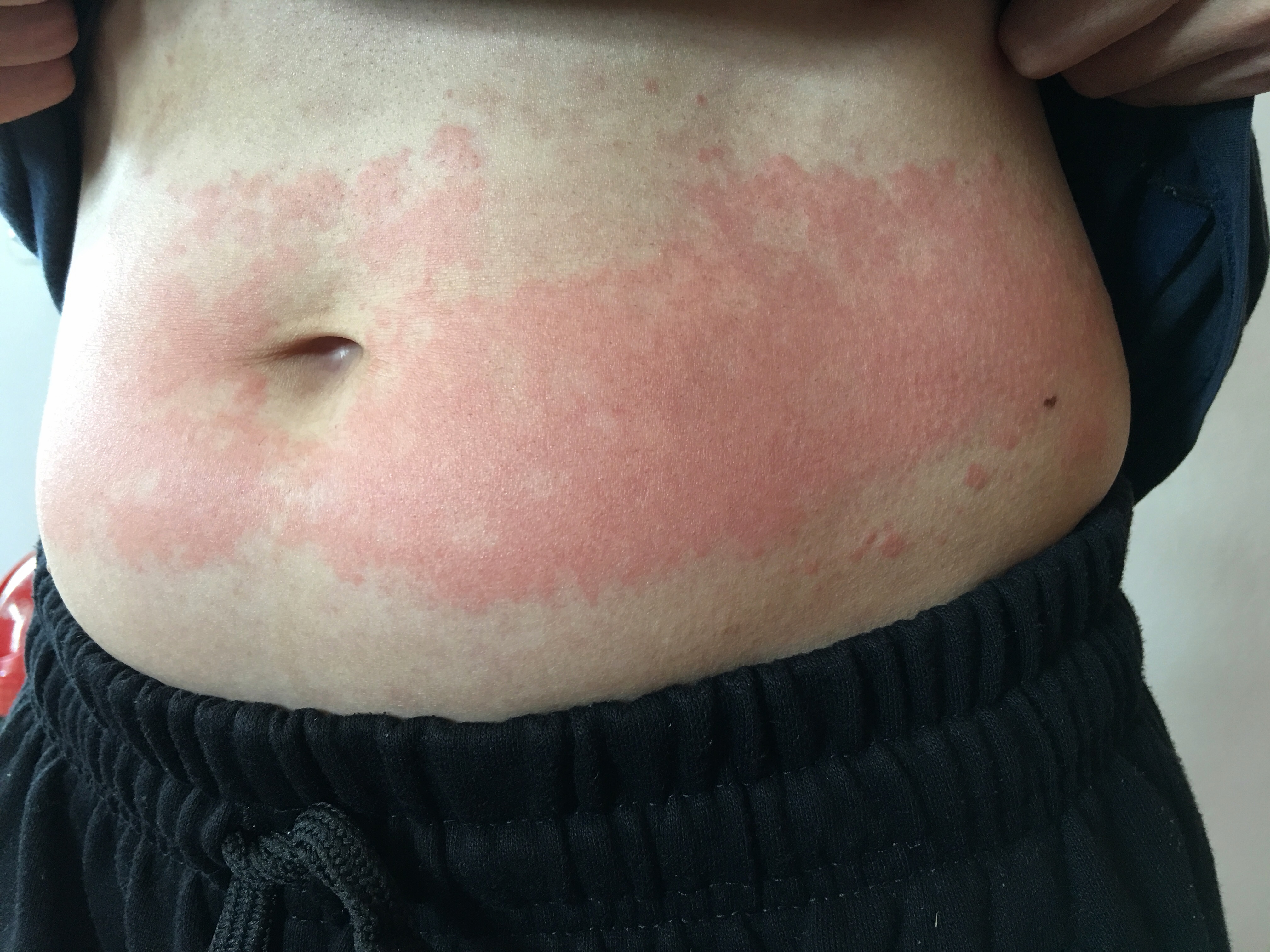 Understanding Postpartum Skin Rashes: Causes and Remedies